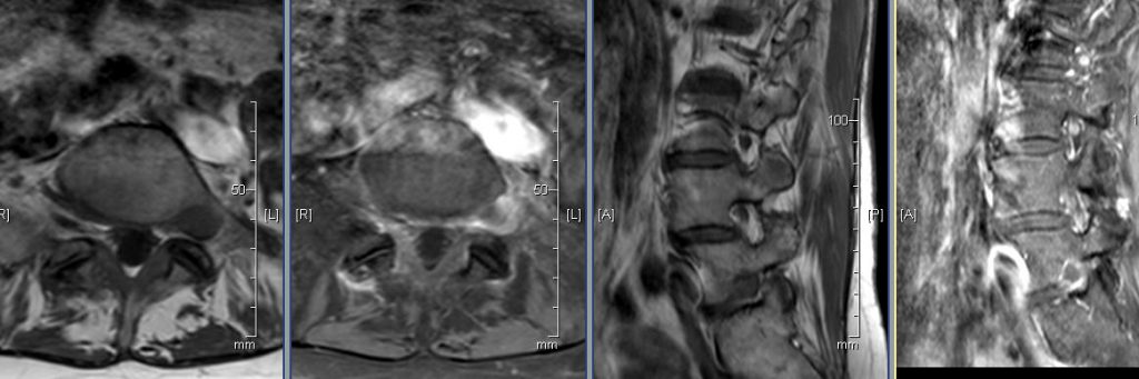 T1 axial pre and post Gad at L5/S1 leve T1 sagittal pre and post Gad at left side.