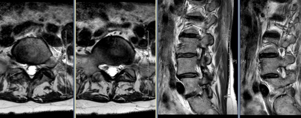 T2 axial at L5/S1 T2 sagittal at left side.