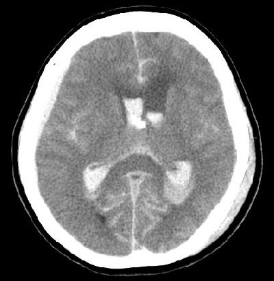 CT Noncontrast