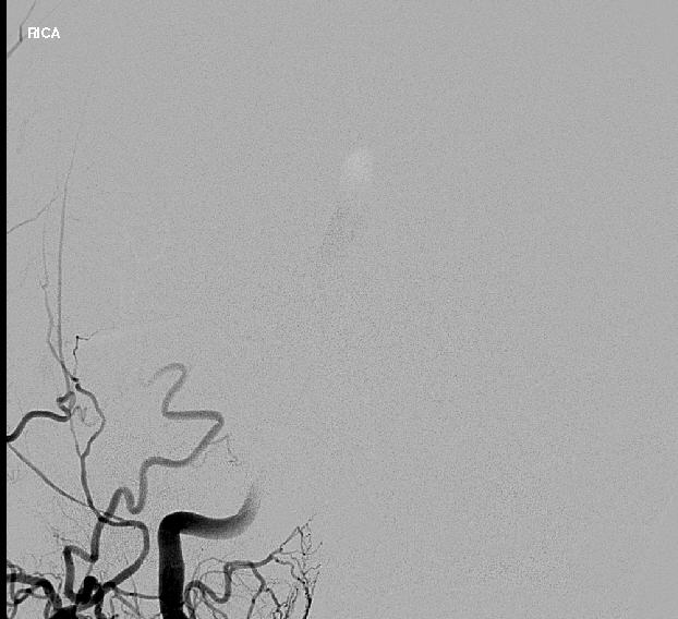 Right Internal Carotid Artery Injection Arterial Phase Frontal View