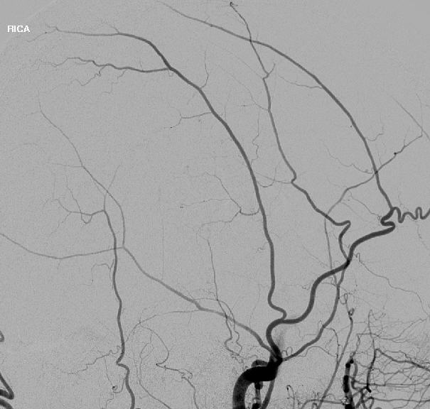 Right Internal Carotid Artery Injection Arterial Phase Lateral View