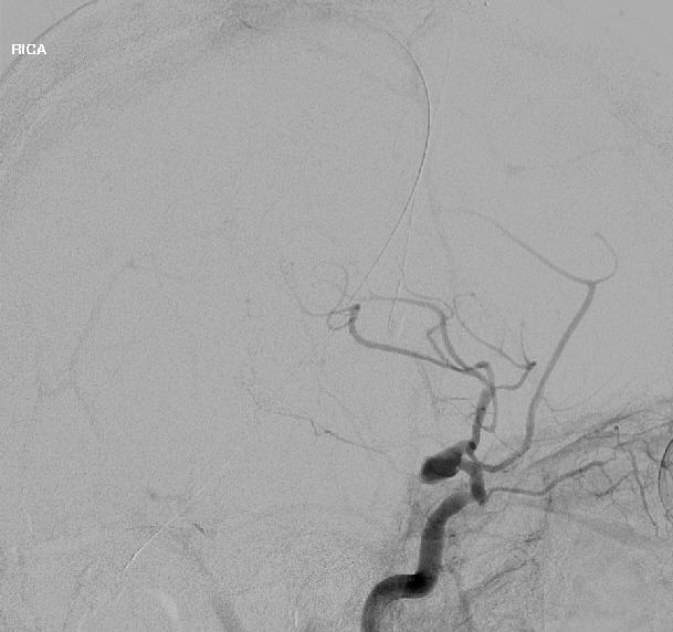 Right Internal Carotid Artery Injection Venous Phase Lateral View