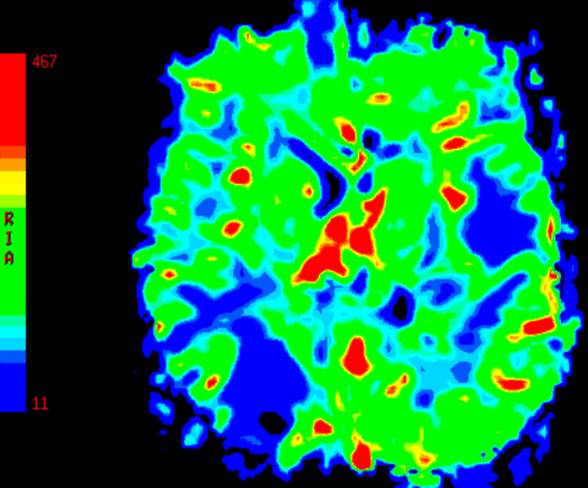 MR perfusion CBV map.