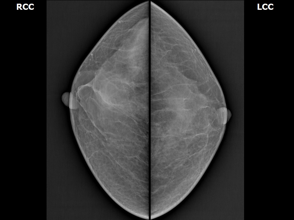 Mammogram.