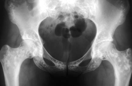 Osteopoikilosis pelvis.