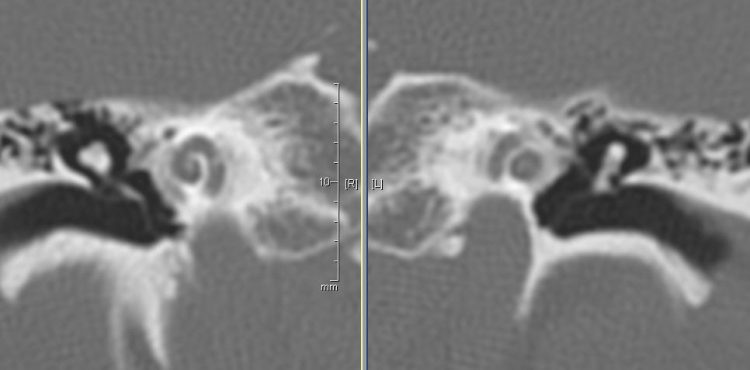 CT Coronal Reconstructions Noncontrast Bone Windows.