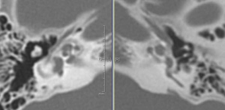 CT Axial Noncontrast Bone Windows.