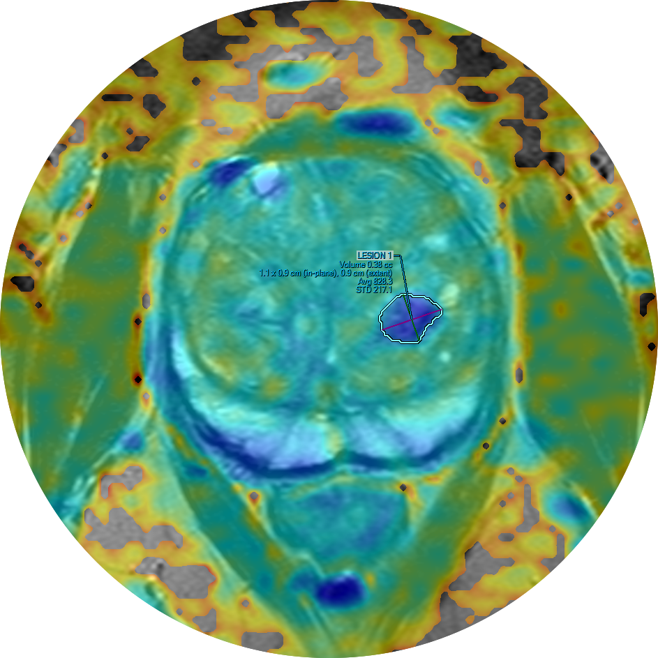 Prostate MRI.