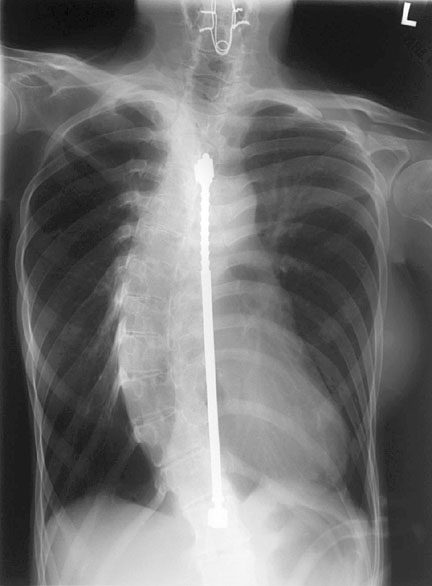 Scoliosis.