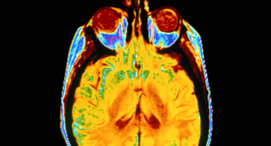 PET/CT Brain.