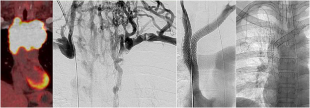 Venous Access.