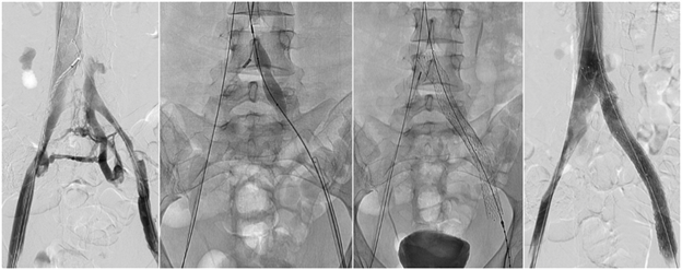 Venous Interventions Image 2 of 2.