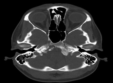 CT axial bone windows.