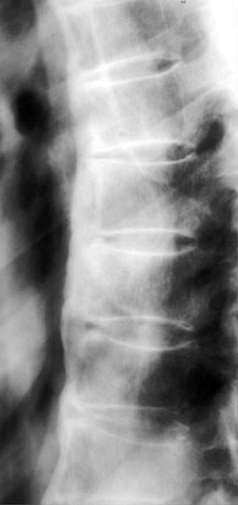 DISH Lat T Spine.