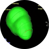 Video example of heart cine imaging.