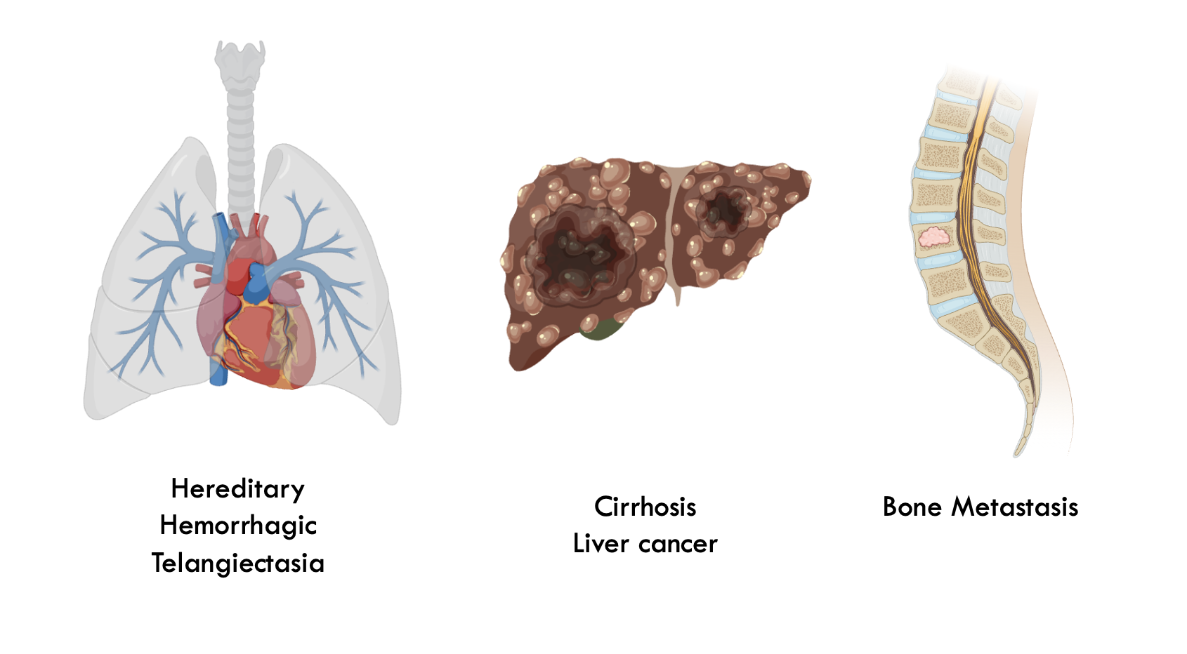 What we work on, HHT, bone mets, and liver disease 