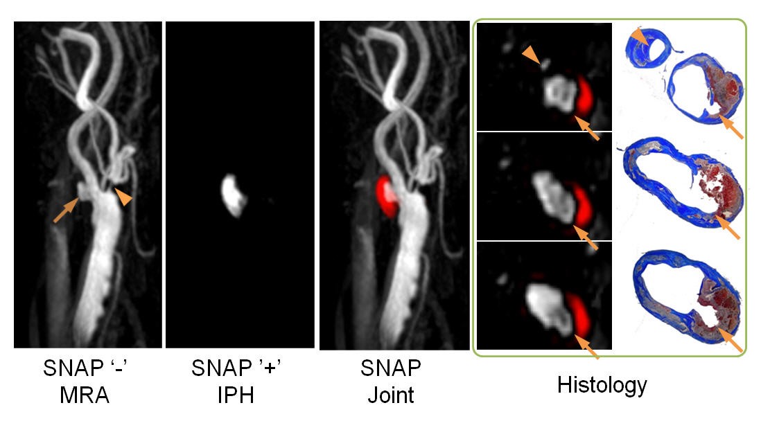 SNAP carotid.